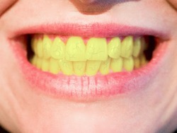 Стоматолог объяснила астраханцам причины желтизны зубов
