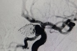 Волгоградские медики спасли пациентку с тяжёлой патологией головного мозга
