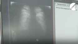 Врачи предупреждают астраханцев о коварстве туберкулёза